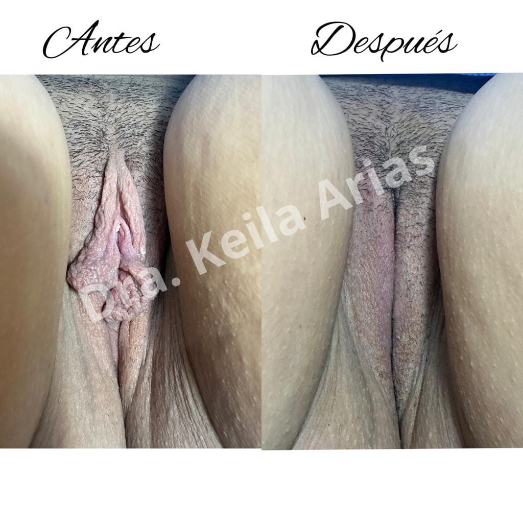 Ilustración referencial de Labioplastía láser